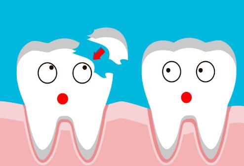 does it cost to fix a chipped tooth​