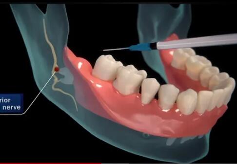 wisdom teeth surgery take
